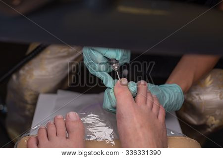 Podiatrist Treating Toenail. Podology Treatment. Podology Of Applying Gel Polish To Remove Onycholys