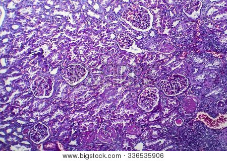 Chronic Nephritis, Light Micrograph, Photo Under Microscope