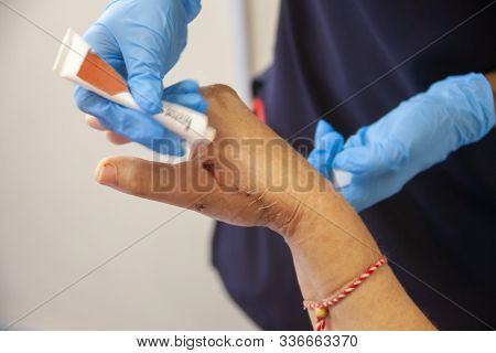 Caucasian woman with broken hands African nurse putting cream on the wounds