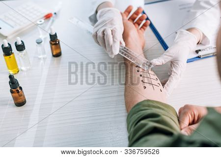 Overhead Of Allergist Holding Ruler Near Marked Hand On Man In Clinic