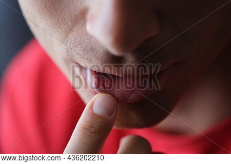 On Male Lip Herpes From Inside Closeup