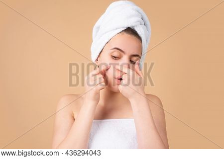 Woman Squeezing Pimples On Her Face. Acne Blemish Spots Skin On Young Woman. Spot Scar Acne, Freckle