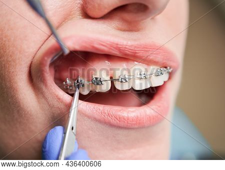 Close Up Of Woman With Brackets On White Teeth Receiving Dental Braces Treatment In Clinic. Orthodon