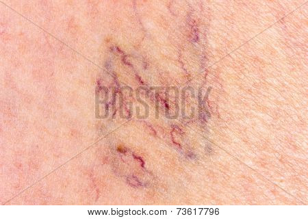 Close-up Of Leg With Varicose Veins