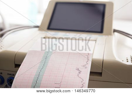 Printing of cardiogram report coming out from Electrocardiograph in labour ward. Fetal monitor