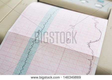Printing of cardiogram report coming out from Electrocardiograph in labour ward. Fetal monitor