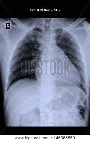 chest xray show heart cardiomegaly and lung