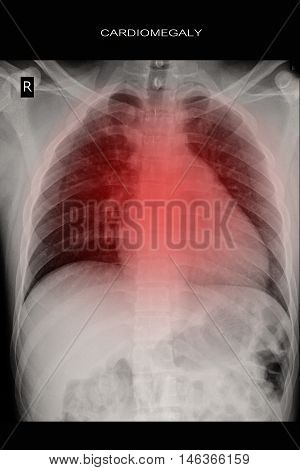 xray image show heart disease and cardiomegaly
