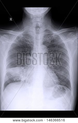 Chest xray PA upright show lung cancer and metastasis