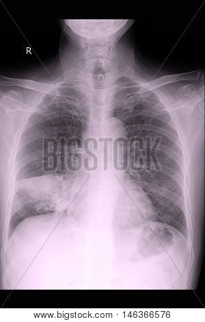 Chest xray PA upright show lung cancer and metastasis