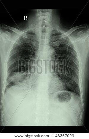 Chest xray PA upright show lung cancer and metastasis