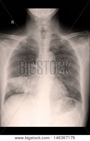 Chest xray PA upright show lung cancer and metastasis