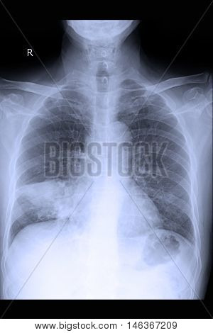 chest xray image show lung mass and lung cancer