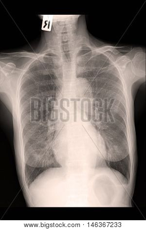 chest xray image show lung mass and CA lung