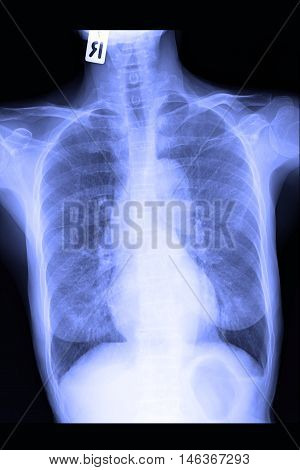 chest xray image show lung and infiltration