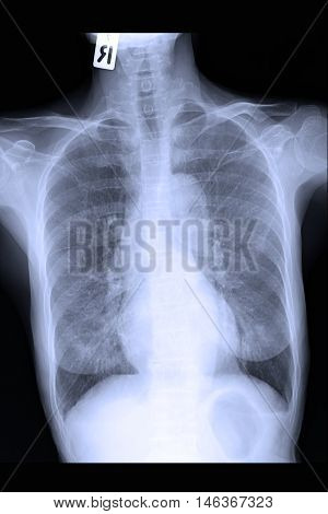 chest xray image show lung and infiltration