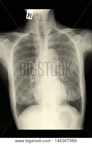 chest xray image show lung and infiltration