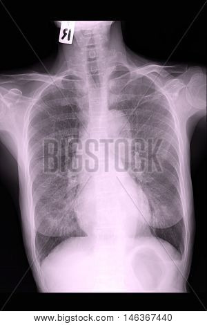 chest xray image show lung and infiltration
