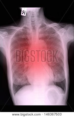 chest xray image show lung and infiltration