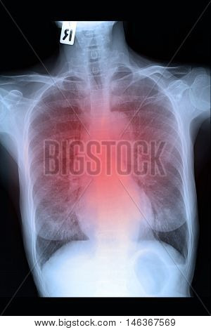 chest xray image show lung and infiltration