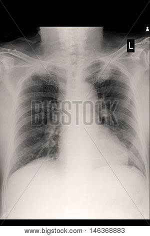 xray image show chest xray and cardiomegaly