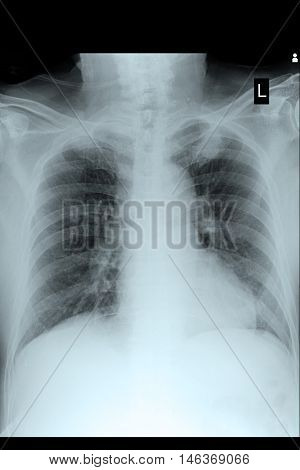 xray image show chest xray and cardiomegaly