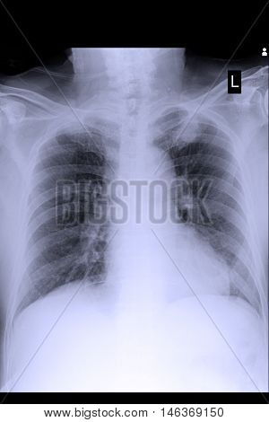 xray image show chest xray and cardiomegaly
