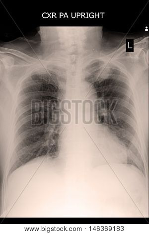 xray image show chest xray and cardiomegaly