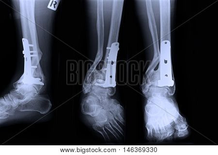 Ankle right joint : fracture ankle right joint