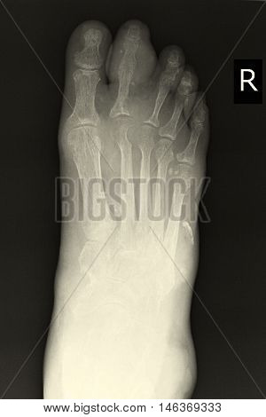 xray image show closed fracture index toe right foot
