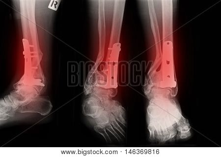 Ankle right joint : fracture ankle right joint