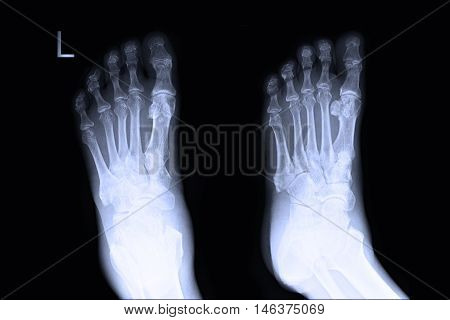 xray image show left foot AP,LAT  and fracture