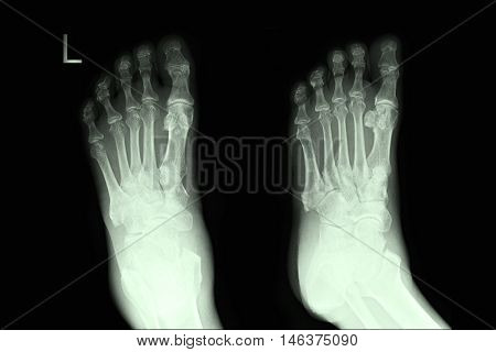 xray image show left foot AP,LAT  and fracture