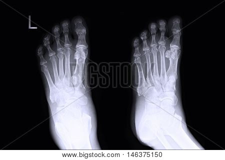 xray image show left foot AP,LAT  and fracture
