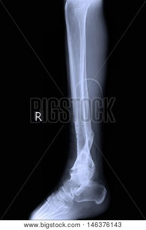 xray image show right foot and closed fracture tibia right