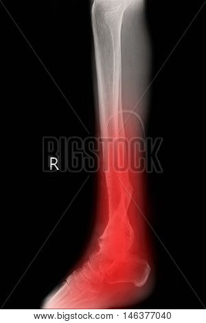 xray image show right foot and closed fracture tibia right