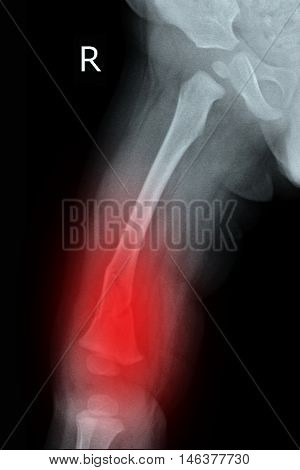 child xray image show fracture right femur