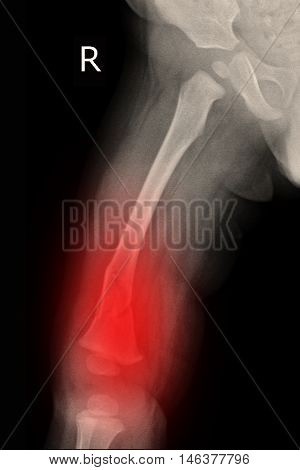 child xray image show fracture right femur