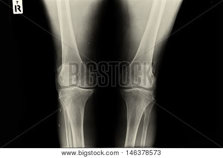XRAY KNEE : Osteoporosis and OA both knee