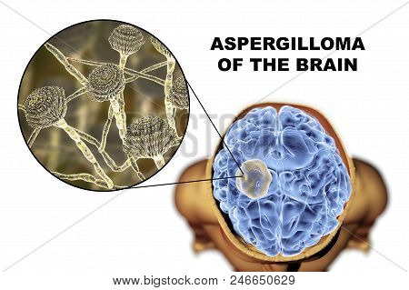 Aspergilloma Of The Brain And Close-up View Of Fungi Aspergillus, 3d Illustration. An Intracranial L