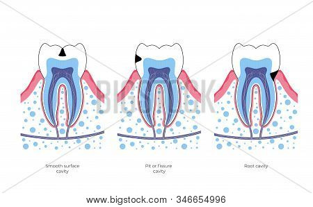 Vector Isolated Illustration Of Tooth With Caries. Types Of Teeth Decay Medical Poster. Banner For D