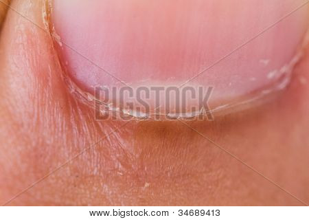 thumb lunule