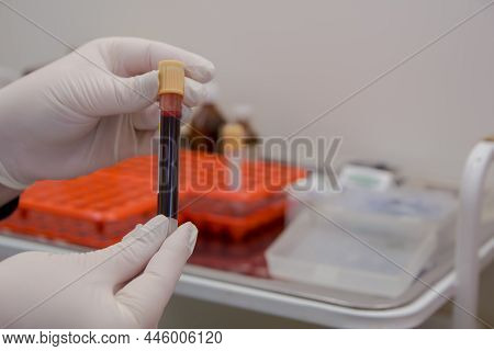 The Doctor Holds A Vacutainer With Human Blood.