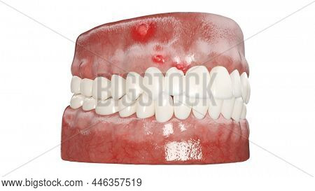 3d rendered illustration of a dental abcess