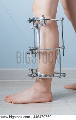 Leg In Ilizarovs External Fixator, Ilizarovs Apparatus