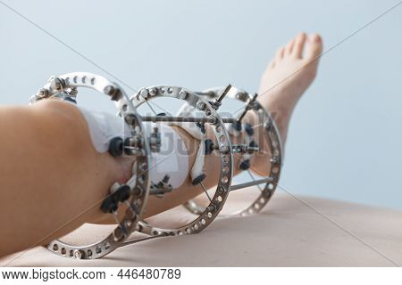 Leg In Ilizarovs External Fixator, Ilizarovs Apparatus