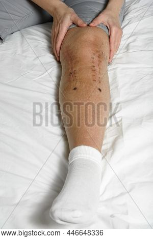 Woman Massaging Postoperative Suture After Leg Fracture. Concept Of Rehabilitation And Recovery Afte