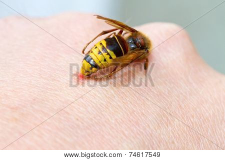 Hornet sting on hand