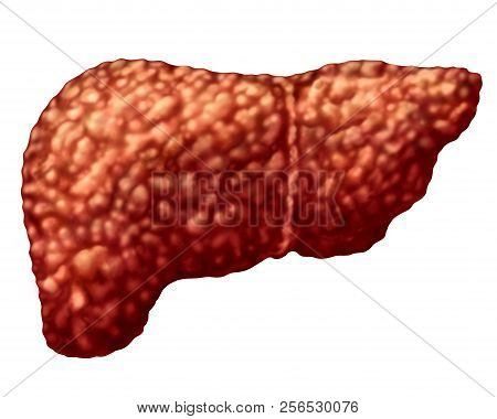 Fatty Liver And Hepatic Steatosis Body Part Isolated On White As A Medical Health Care Concept Of Th