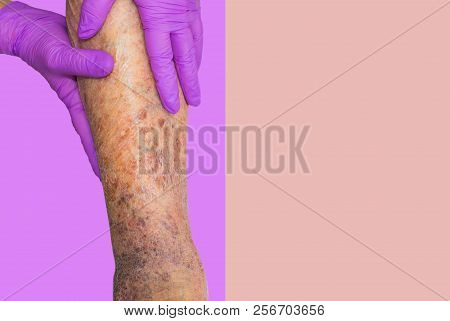 Close-up Of Skin With Varicose Veins On Senior Male Leg. Concept Of Dry Skin, Old Senior People, Var
